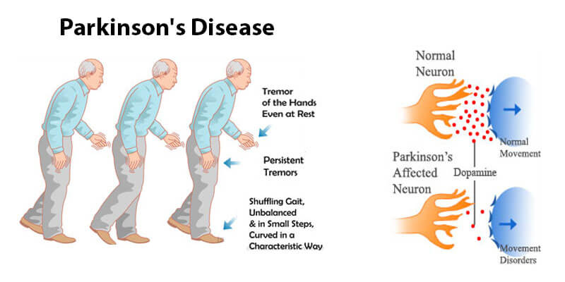 parkinson